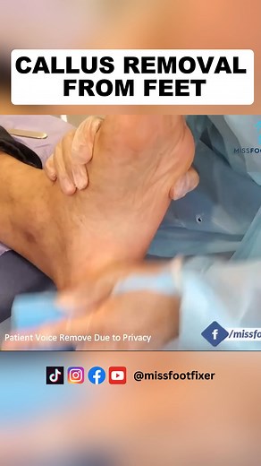 3.6K views · 16 reactions | callus Removal From Feet | Miss Foot Fixer | Marion Yau #footcallusremoval #callusremoval #CallusRemover #missfootfixer | Miss Foot Fixer | Facebook