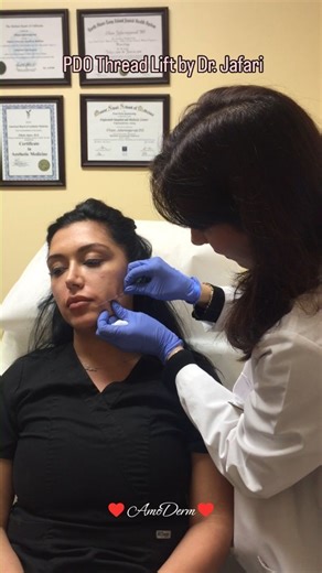 �👁 Watch Dr. Jafari performing PDO thread lift procedure ____ 📋 During PDO Thread Lift procedure, Dr. Jafari first inserts the needle cartridge that contains the PDO thread under the skin through a small opening. She then pulls the cartridge out, leaving the thread under the skin. The thread has small "barbs" on its side which anchor and hold it in place. Dr. Jafari sculpts and massages the skin over the thread, engaging the barbs and further lifting the skin. The barbs on the thread prevent t
