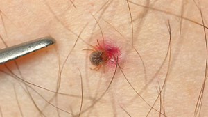 Close-up of Tick Embedded in Stock Footage - Video of blood, wildlife: 317782302