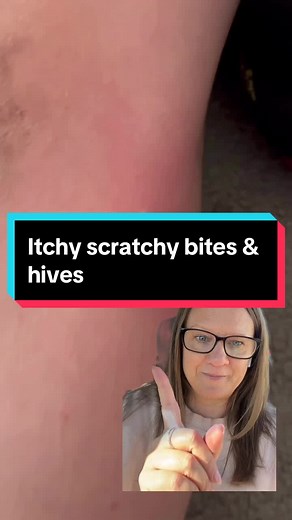 Understanding Hives in Children: Causes and Treatment