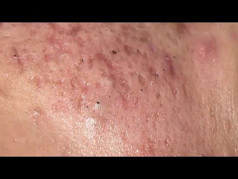 RELAXING WITH NASA SPA || SQUEEZE ACNE VIDEO #38