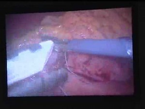 Gastric Bypass Surgery