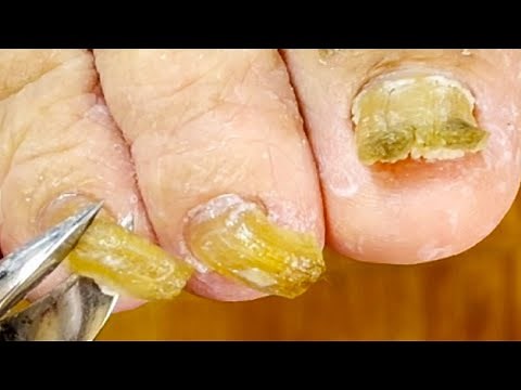 Deformed Toenails, Trim Them Cleanly Bit By Bit【Podiatry Clinic】