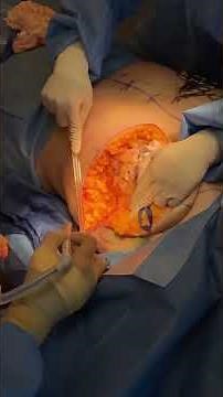 Transgender TOP Surgery! Before and After with Amazing Results!