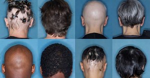 FDA approves 1st drug treatment for alopecia hair loss