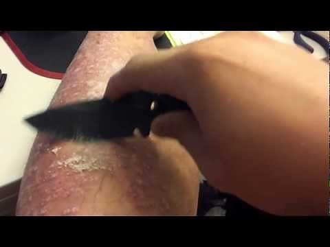 Plaque psoriasis scrape