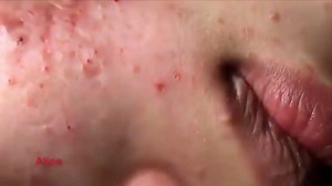 How To Remove Blackheads Easy - Worst Case Removal Blackheads On The...