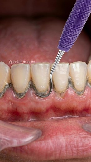 The Art of Debridement: Breaking the Calculus Bridge 🦷✨ What you’re seeing is the mechanical removal of heavy subgingival and supragingival calculus. Over time, dental plaque mineralizes into these hard deposits, creating a