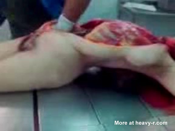 19yo Female Autopsy