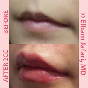 👁 Lip augmentation and enhancement 👄 _____________________ 💉 Procedure: Dermal filler injection in lips by experienced MD _____________________ 🎯 Purpose: Adding volume to the lips to create pouty and better-defined lips with a balanced and natural appearance without surgery and down-time _____________________ 💊 Products used: Typically Juvederm, Voluma, Restylane Lyft (Perlane), Restylane Kysse or Volbella _____________________ 🌹 Results: Results appear immediately but may take up to 2 we
