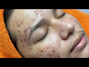 5 Simple TRICKS to Clear Skin with Loan Nguyen