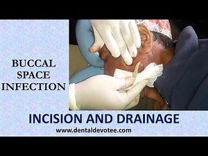 Incision and Drainage of Buccal space infection by Dr. Raman Dhungel