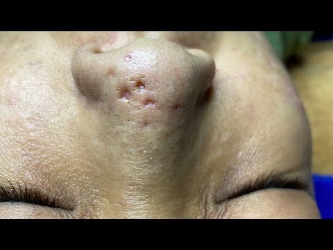 Nose Acne Pitting Scars | Mụn Gây Sẹo Rỗ Ở Mũi - SacDepSpa#199