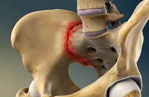 Sacroiliac (SI) Joint Pain | Causes, Symptoms, and Treatments