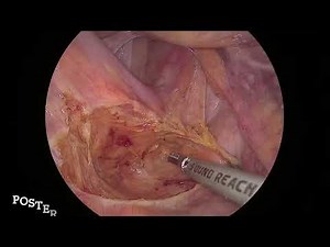 Laparoscopic Ventral Mesh Rectopexy for Complete Rectal Prolapse