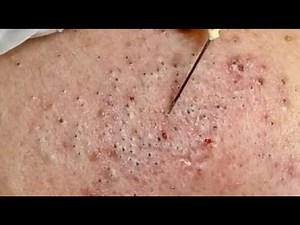 Blackheads & Milia, Big Cystic Acne Blackheads Extraction Whiteheads Removal Pimple Popping #00