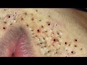 Treatment Of Blackheads And Hidden Acne #063