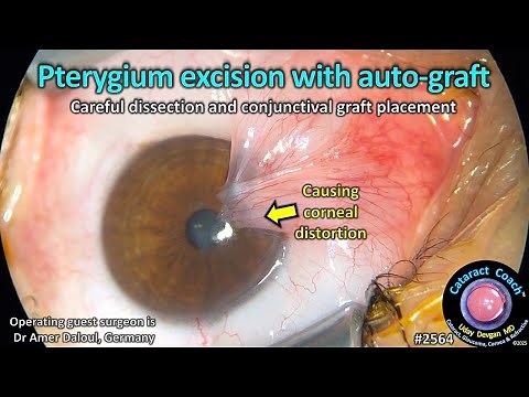 CataractCoach™ 2564: pterygium excision with conjunctival auto-graft