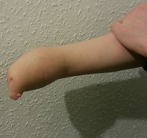 Amelia (birth defect) - Alchetron, The Free Social Encyclopedia