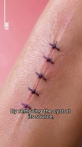 How ganglion cysts are removed