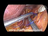 Sleeve and Hiatoplasty • Video • MEDtube.net