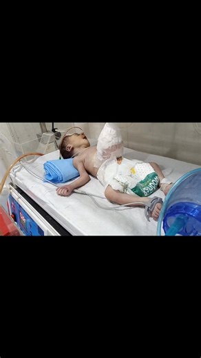 Newborn Baby Resuscitation Life-Saving CPR with Ambu Bag in Critical Condition | NICU Emergency Care #baby #nicucare #NEW #newbornbaby #newborn In this video, we share a real-life NICU emergency where a newborn baby required immediate resuscitation and Ambu bag CPR to save a precious life. Watch the dedicated neonatal team perform life-saving steps with care, skill, and compassion. ❤️‍🩹 👶 Case: Newborn in critical condition requiring CPR and Ambu bag ventilation 🏥 Procedure: Neonatal Resuscit