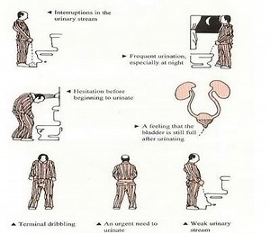 Mnemonic based approach to grading and planning treatment for BPH