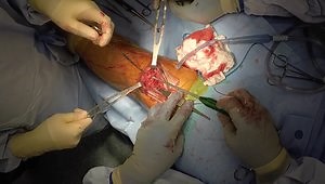 Knotless Fibertape Quadriceps Tendon Repair