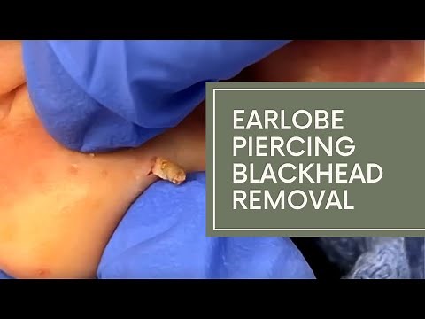 Earlobe Piercing Blackhead Removal | DrDerm