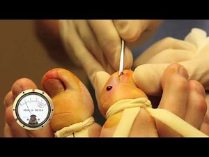 Ingrown Toenail Surgery- WARNING GROSS with Pain-O-Meter