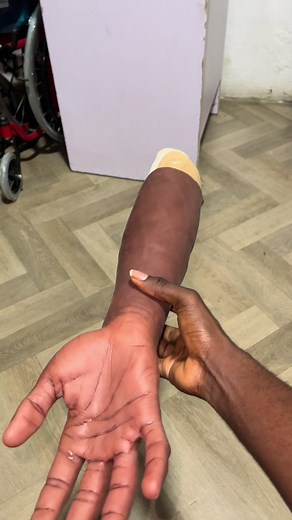 Done 📌 #artificiallimbs #prosthesis #prosthetichand #healthcare #goviralvideo