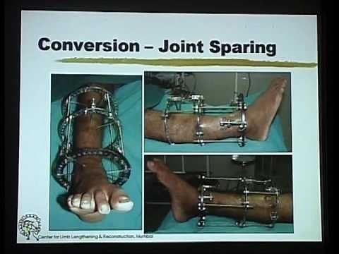 BOS Master Cares Pilon Fractures Dr Mangal Parihar