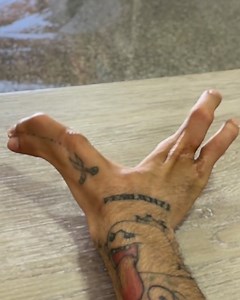 The condition is called ectrodactyly 😯 | UNILAD