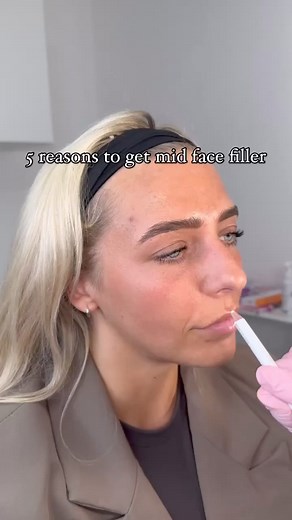 Why should I have midface dermal fillers? There are 5 reasons.​1. Midface fillers can help minimise the signs of ageing, such as nasolabial folds (nose to mouth lines), marionette lines (mouth to chin lines), jowls (the areas that hand over the jawline) and of course, can minimise the signs of the tear trough.​These signs are often just symptoms of midface loss and treating the nasolabial folds, marionettes, tear trough or jowls with filler is only treating a symptom, but not addressing the actu