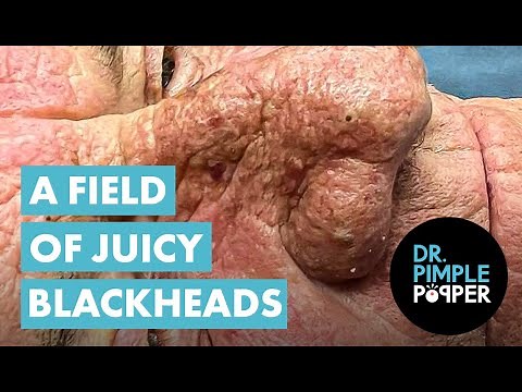 A FIELD OF JUICY BLACKHEADS