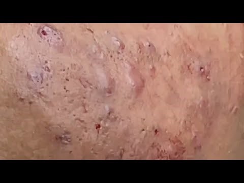 Extreme Acne Treatment 2