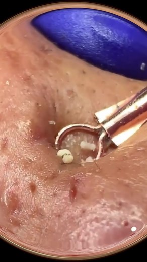 Effective Techniques for Removing Pimples and Blisters