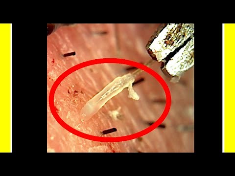 Removing Hair By The Root