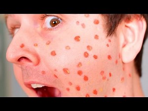 WORST CHICKEN POX EVER!