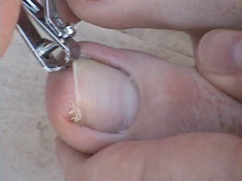 How to Remove an Ingrown Toenail