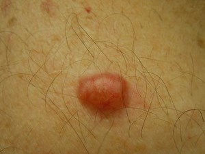 Imagem de Spitz Nevus - Pele-Problemas-E-Tratamentos 2026