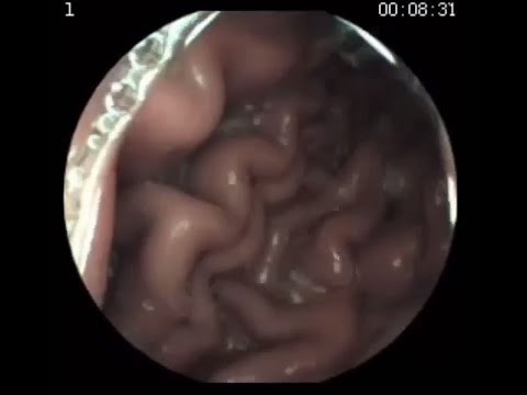 Girl swallow pillcam endoscopy