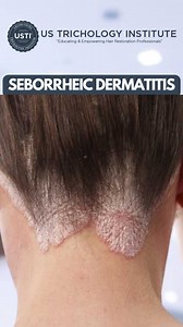 Managing Seborrheic Dermatitis: Strategies for Relief and Control . . . #hairstyle #shampoo #hairloss #conditioner #hairtransplant #hairtransplantation #hair #trichologist #trichology #alopecia | United States Trichology Institute | Facebook