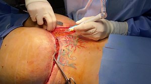 Traditional Buttock Lift by Dr. Salama | Elite Plastic Surgery (GRAPHIC)