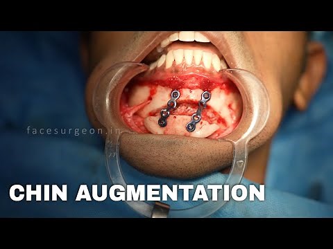 Chin Implant Surgery for Male | PLASTIC with Dr. Sunil Richardson