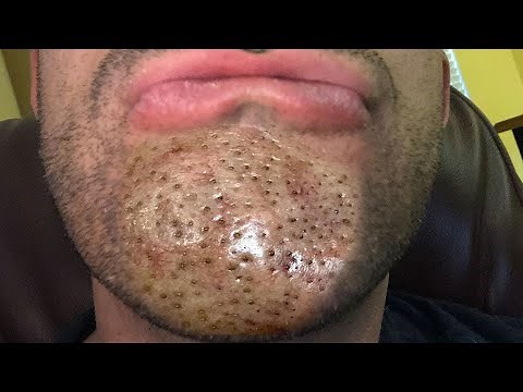 What Are Chin Pimples, Ear Blackheads and Nose Whiteheads?