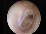 Large Center Eardrum Perforation • Video • MEDtube.net