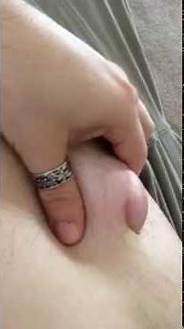 My Umbilical Hernia Open Mesh Repair Journey. Video 1