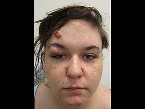 FLYING PIMPLES IN EARS (POPPING PIMPLE IN EAR) - All pimples channel -