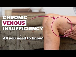 Complete Guide of Chronic Venous Insufficiency: Symptoms, Causes & Treatments
